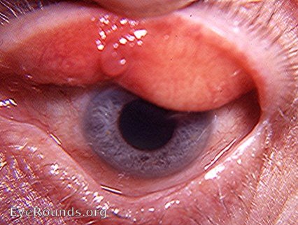 Granulation tissue exuding from site of recent chalazion surgery