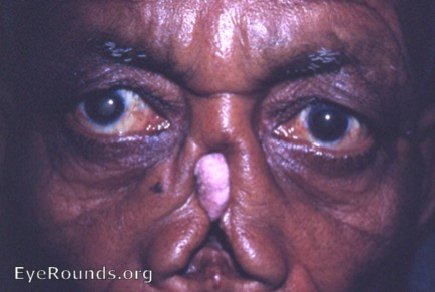 Syphilis and trachoma: tertiary syphilis with gumma distruction of nose; also s-curve of right upper lid due to trachoma.