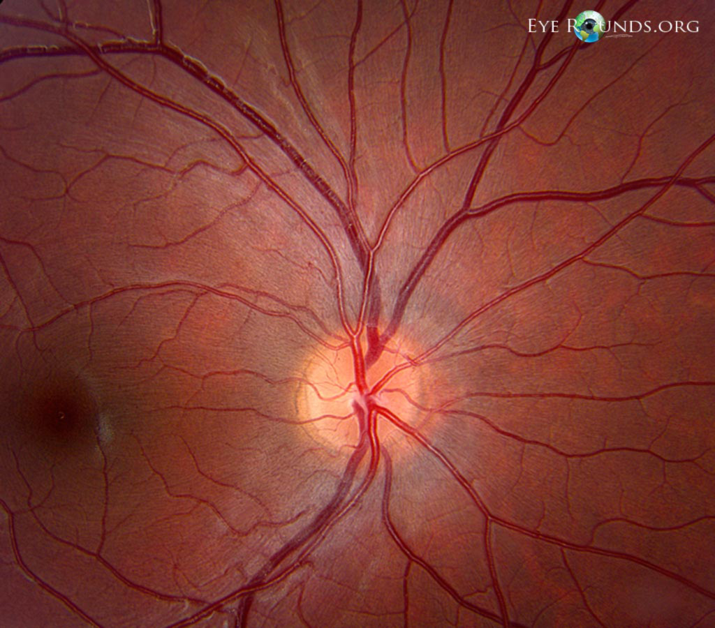 dots, superior to the optic disc OD