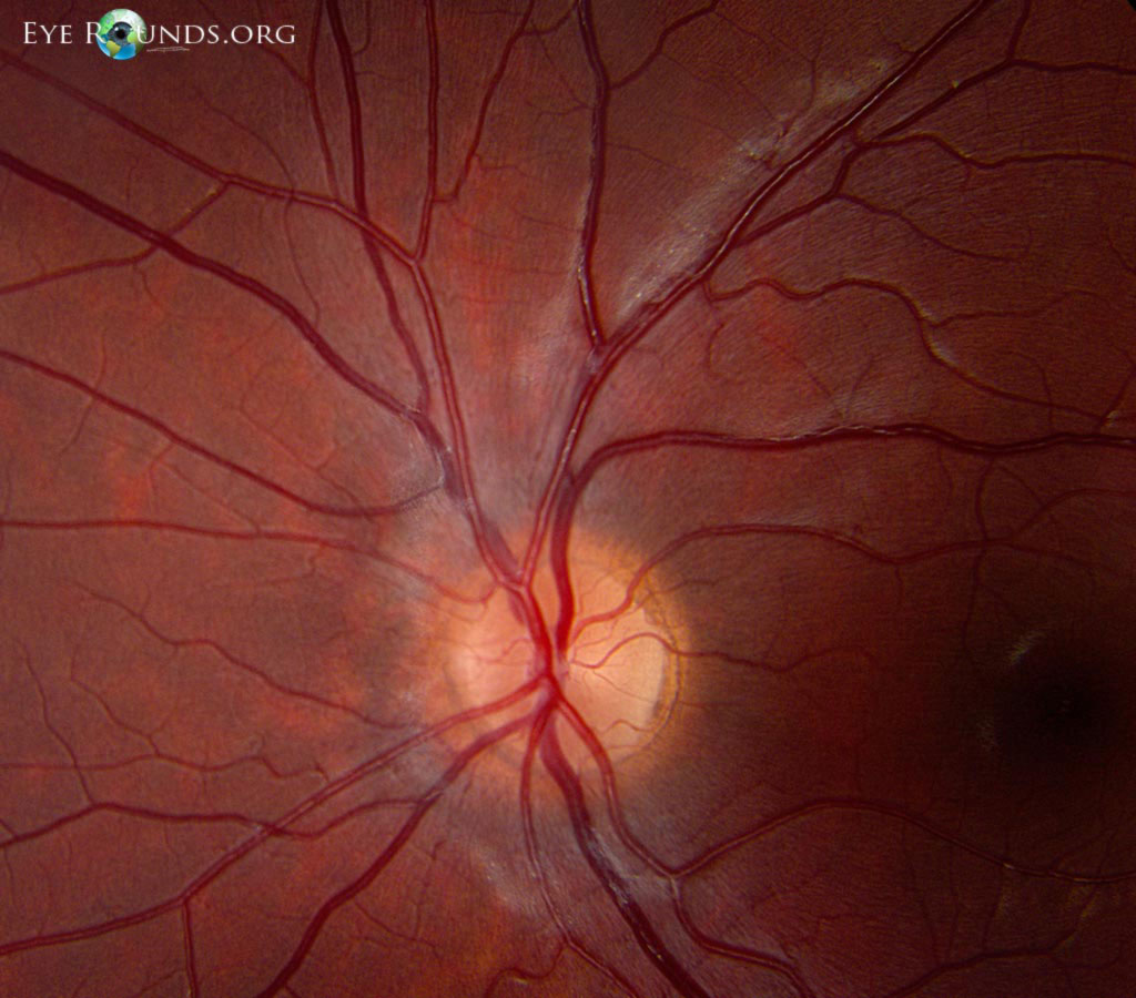 dots, superior to the optic disc OS