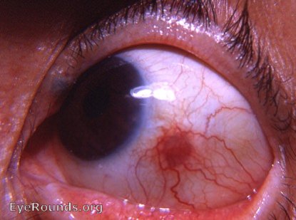 healing nodular episcleritis