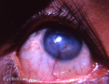 Leukomatous cornea; heavy neovascularization