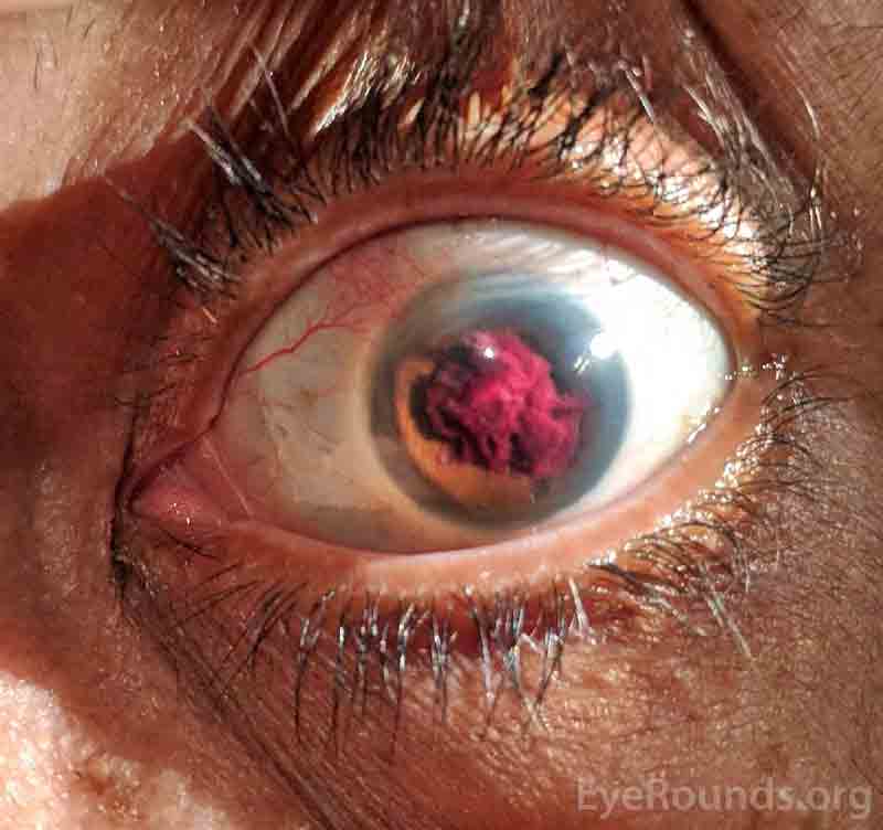 contracting post-operative hyphema two weeks after an iStent