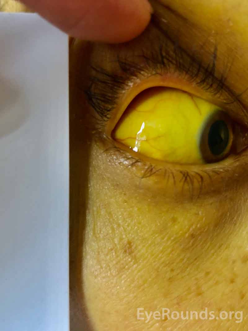 positive scleral icterus