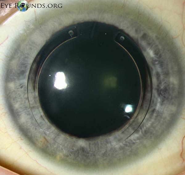 Intrastromal corneal ring segments (aka intracorneal rings, Intacs)