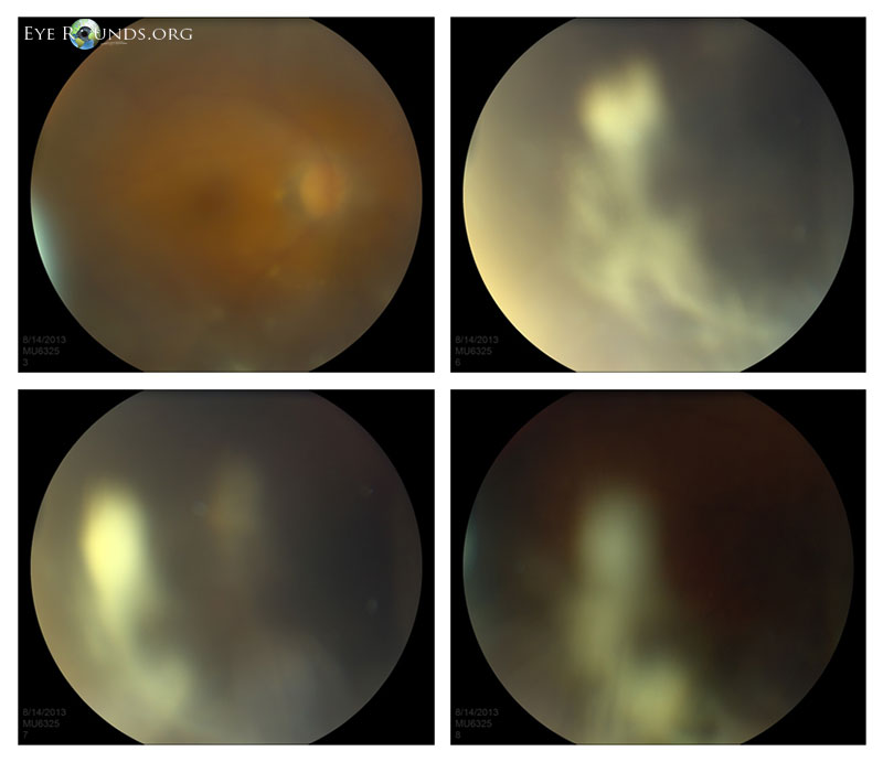 Dilated fundus exam of the right eye immediately following intravitreal injection of 2 mg (0.05 mL) triamcinolone