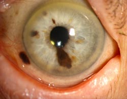 iris melanoma