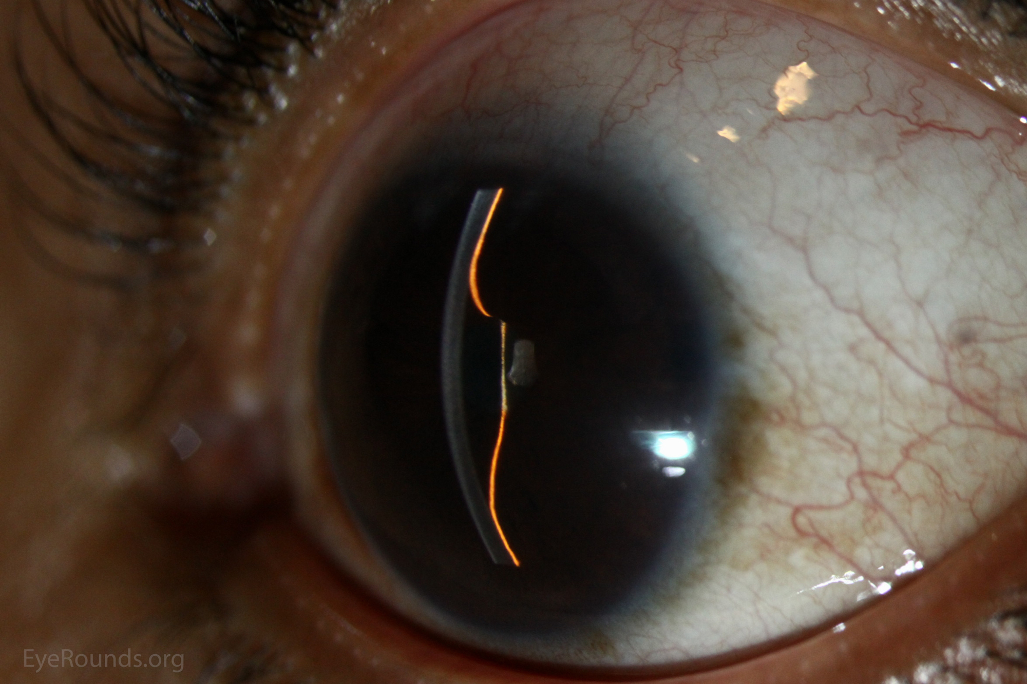slit lamp iris bombe developed in this patient with chronic iridocyclitis and central posterior synechiae.