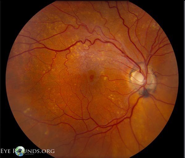 fundus showoing small lamellar hole at the fovea center and an epiretinal membrane worse between the fovea and superior arcades