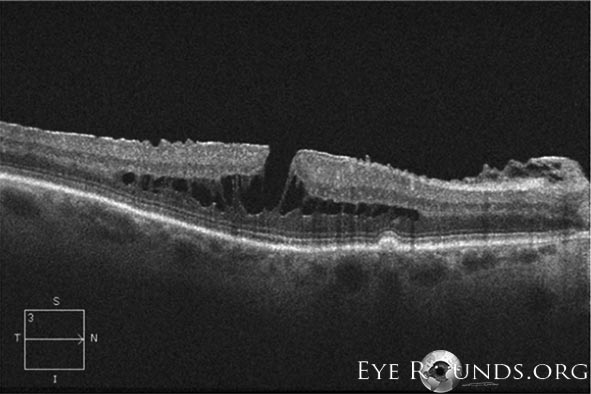 Lamellar Hole with Foveal Schisis