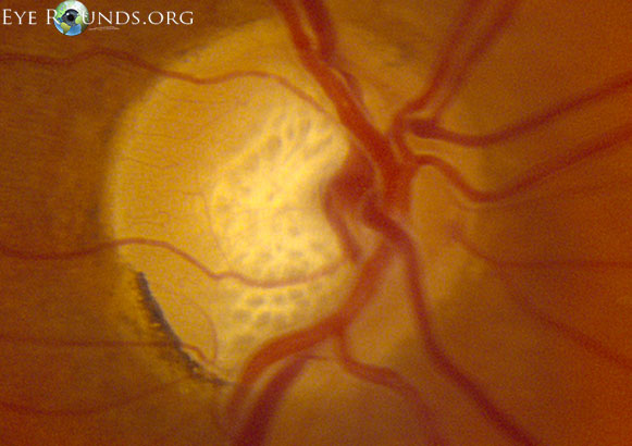 zoomed in fundus shwoing deep optic nerve head cup and prominent inferotemporal notch secondary to optic nerve damage from primary open angle glaucoma
