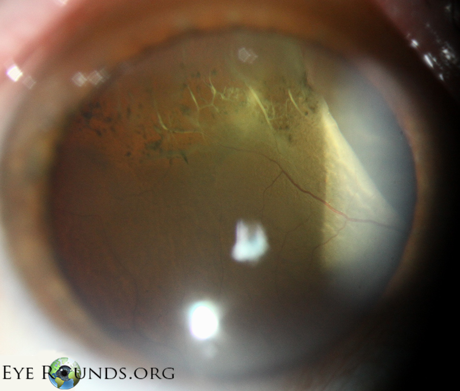 Atlas Entry - Lattice Degeneration of peripheral retina