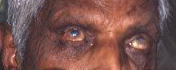 leprosy: patient is blind due to leprotic uveitis and keratitis