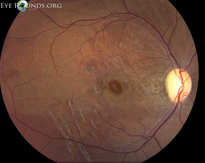 fundus  blunt eye injury during a severe motor vehicle accident and has several retinal sequellae from the incident
