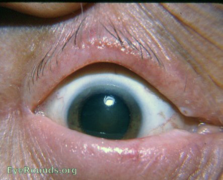madarosis/ milphosis: loss of eyelashes in a patient with rosacea