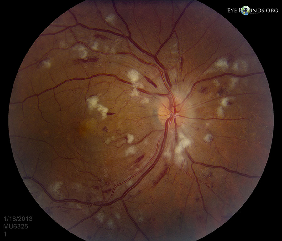 Fundus Photo. Patient is a 52-year-old male with malignant hypertension