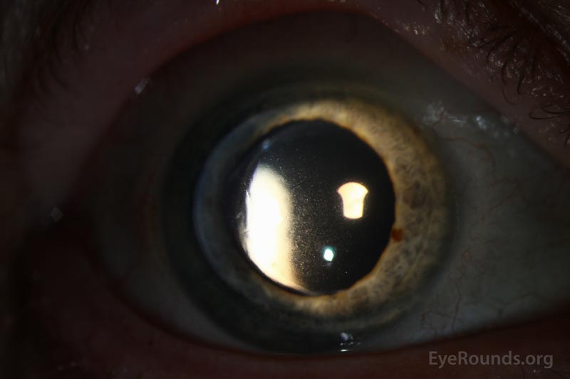 Mapdotfingerprint dystrophy