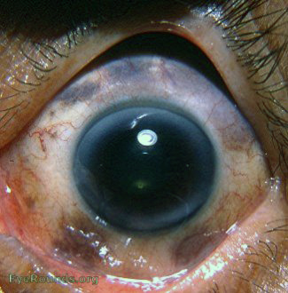 melanosis oculi wih pigmentation of tarsal conjunctiva near lid margin