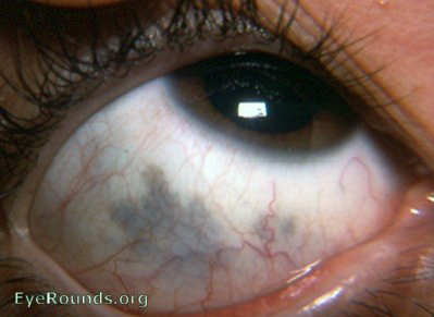 melanosis oculi wih pigmentation of tarsal conjunctiva near lid margin