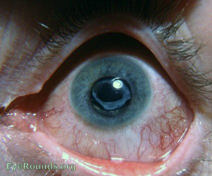 membranous cataract - remnant of congenital cataract through self-absorption