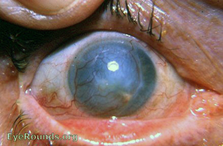 metaherpetic keratitis - a second case