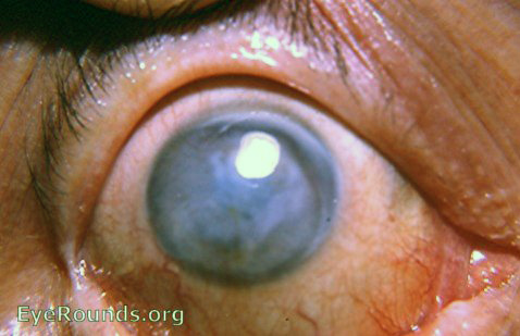 metaherpetic keratitis