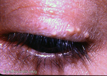 milia of skin of upper lid