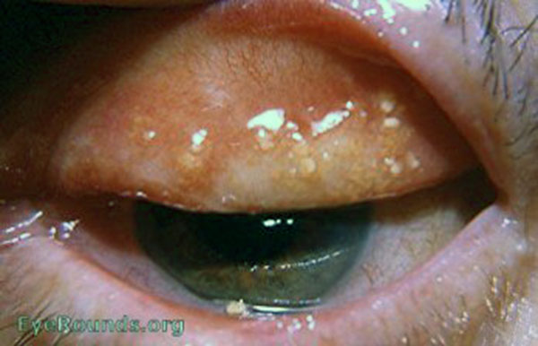 multiple meibomian infarcts