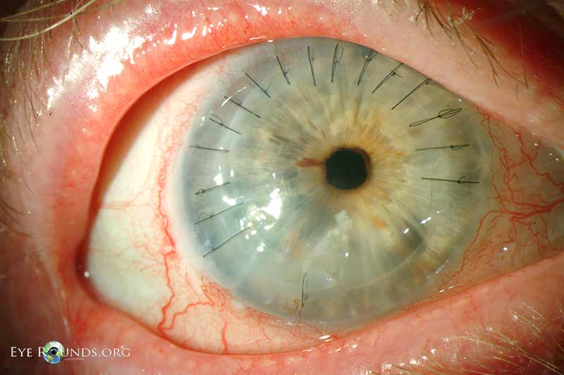 Mycobacterial keratitis