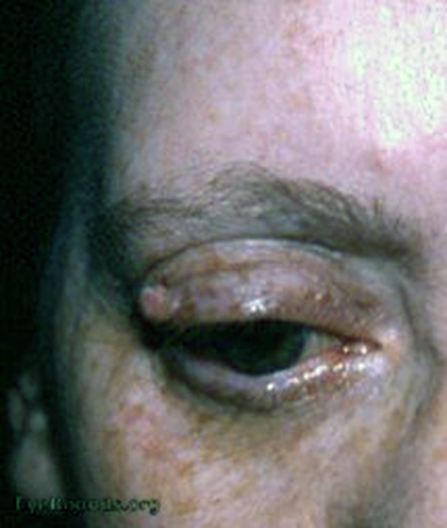 papilloma - right upper lid