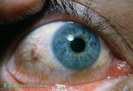 pigmented nevus of bulbar conjunctiva