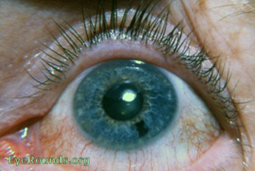 pigmented nevus of iris