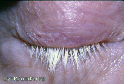 poliosis of lashes