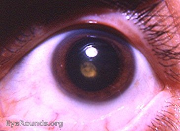 cataract - congenital posterior polar cataract