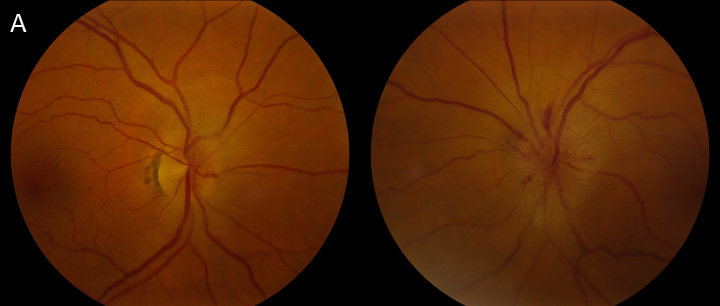 acute vision loss in the left eye and was noted to have disc edema with peripapillary hemorrhages OS and trace hyperemic disc edema OD (A) from non-arteritic ischemic optic neuropathy (NAION) OS and incipient NAION OD