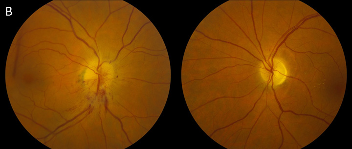 Three months later, he developed acute painless vision loss OD. Dilated fundus examination at that time showed diffuse pallor OS and hyperemic sectoral disc edema OD (B)