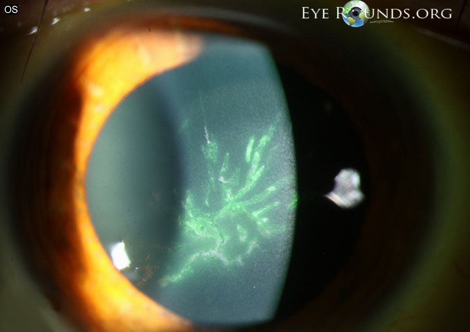 herpes zoster epithelial keratitis with pseudodendrites of the right eye
