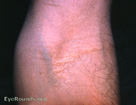 pseudoxanthoma elasicum - upper forearm/ Groenblad-Strandberg Syndrome