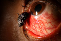pyogenic granuloma