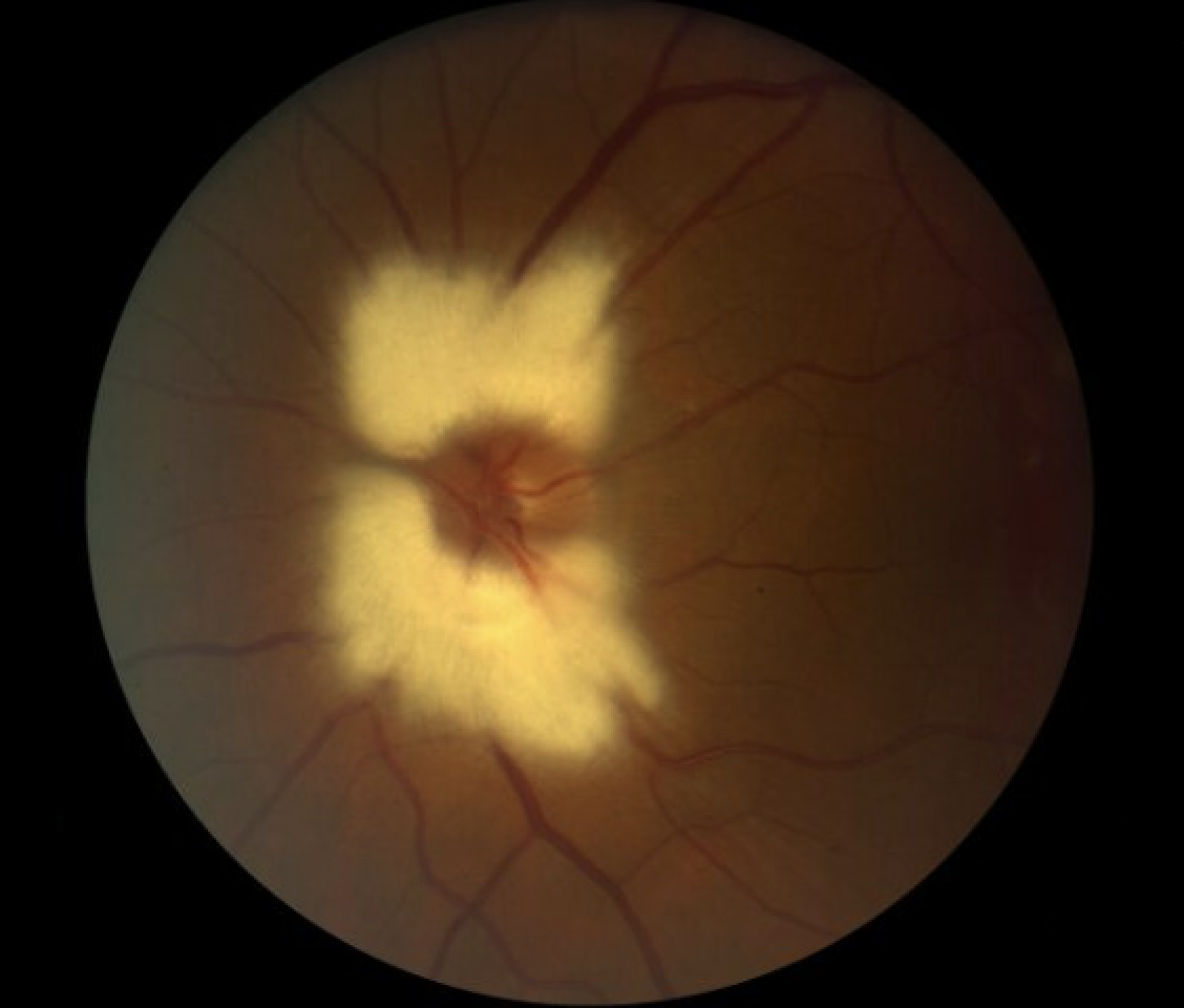 patient with myelinated nerve fiber layer in the left eye