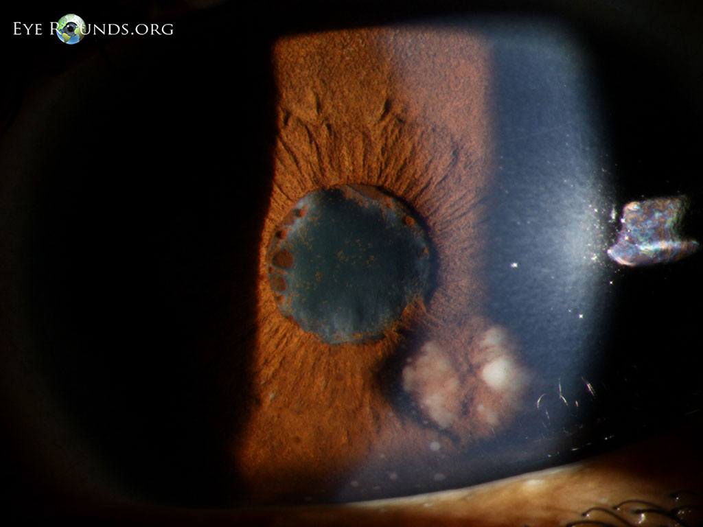 Sarcoid Uveitis