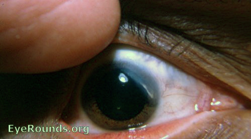 Sclerosing keratitis. EyeRounds.org: Online Ophthalmic Atlas