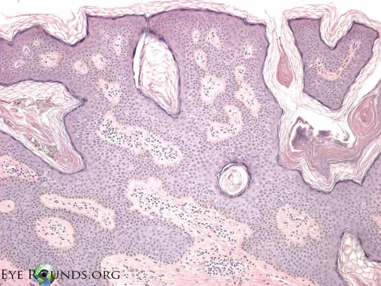 Histologically, seborrheic keratosis contains acanthosis, hyperkeratosis, and papillomatosis