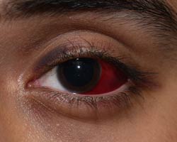 Subconjunctival Hemorrhage