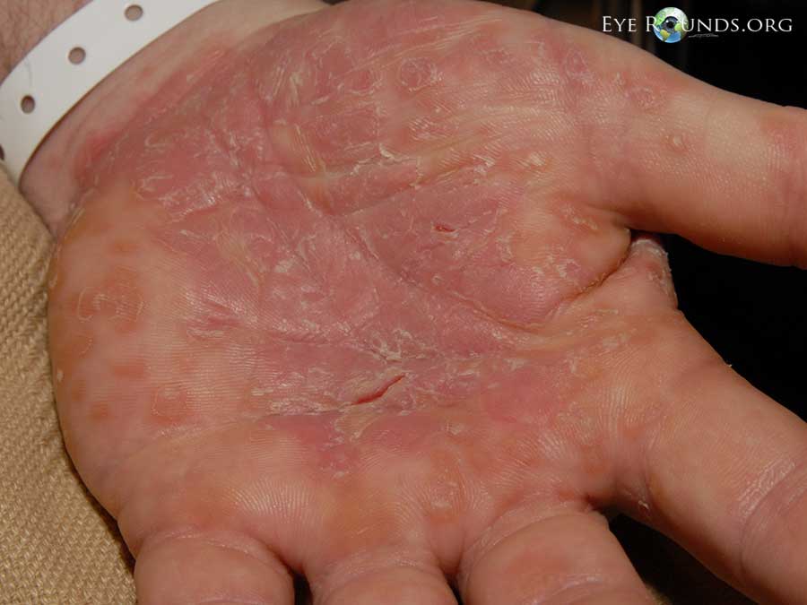 syphillis on palm of hand