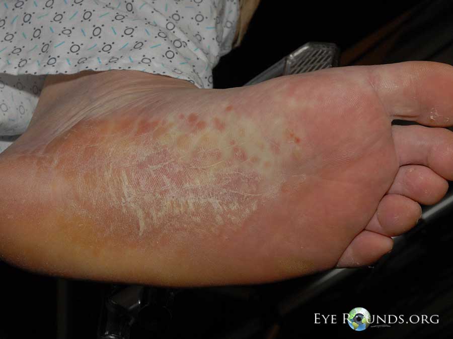 syphillis on sole of foot