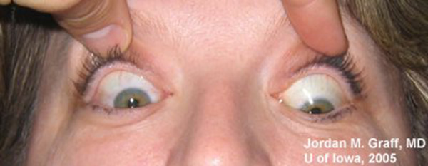 thyroid eye disease down gaze