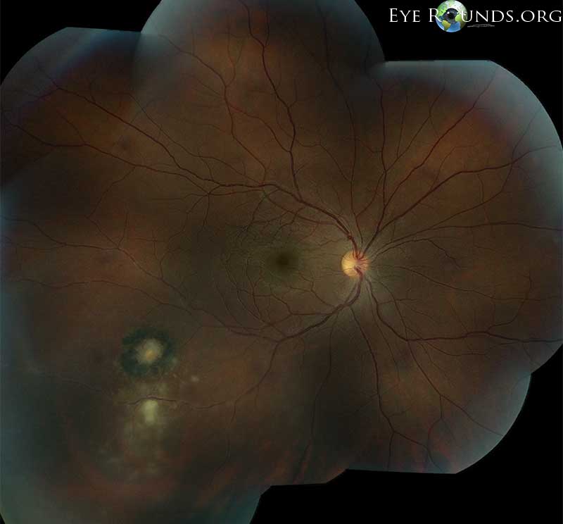 Ocular Toxoplasmosis: The University of Iowa, Ophthalmology