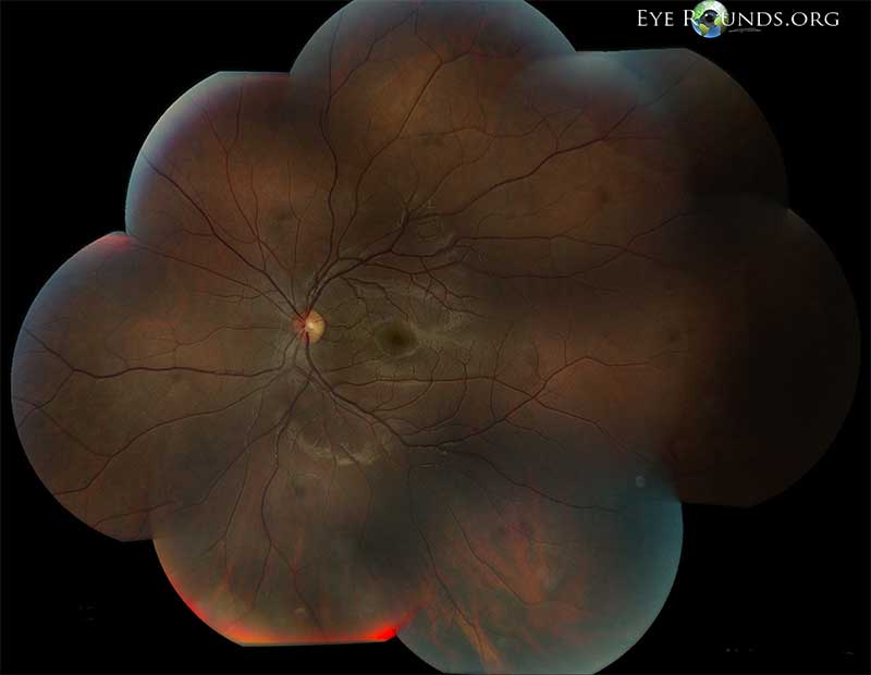 Ocular Toxoplasmosis: The University of Iowa, Ophthalmology