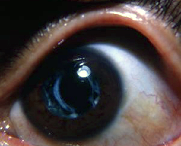 posterior lens capsule remnants following needling of traumatic cataract os